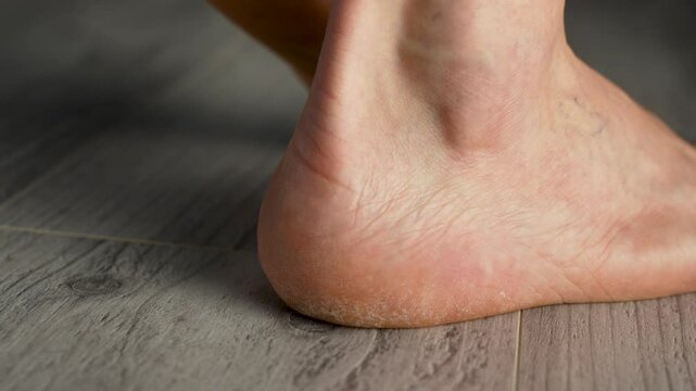 Dry and cracked man's heel, close-up. Feet with dry skin on sole