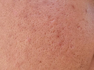 pores and oily on surface asian man face 2