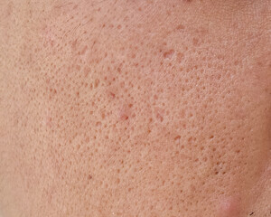 pores and oily on surface asian man face
