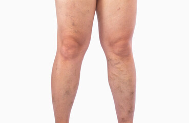 Removal of varicose veins on the legs. Medical inspection and treatment of Telangiectasia. Phlebeurysm.