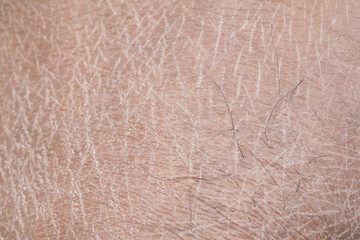 Closeup view of dry human skin .