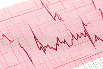 ECG Waveform Illustration