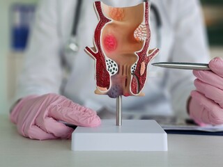 Doctor holds pen and rectum model with inflammation concept