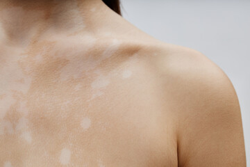 Close up on collarbone of young woman with vitiligo celebrating natural beauty of skin patches in unique pattern in studio, copy space