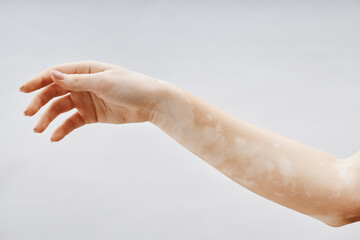 Close up on female arm in elegant gesture showcasing skin with vitiligo patches in beautiful unique...
