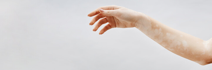 Website header shot of female arm with vitiligo patches in elegant gesture against white backdrop in studio, copy space