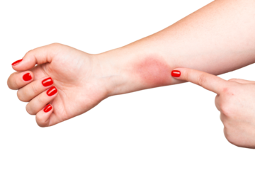 Woman showing strong fire burn on hand skin with red nails isolated on white background.