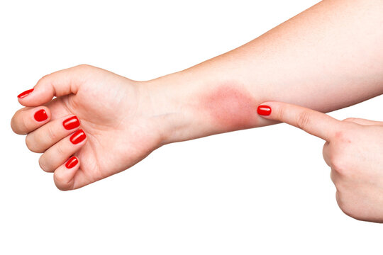 Woman showing strong fire burn on hand skin with red nails isolated on white background.