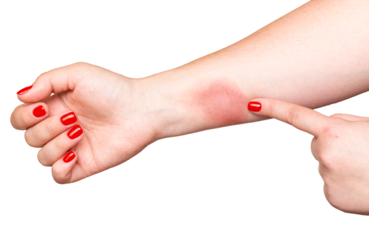 Woman showing strong fire burn on hand skin with red nails isolated on white background.