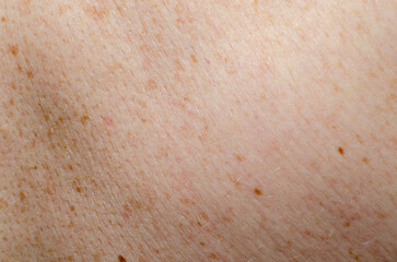 Nevus on human skin close-up