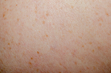 Fototapeta premium Nevus on human skin close-up
