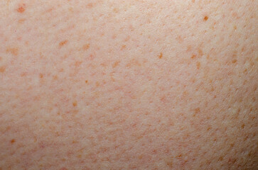 Fototapeta premium Nevus on human skin close-up