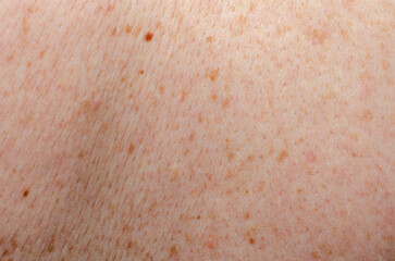 Nevus on human skin close-up