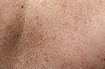 Nevus on human skin close-up