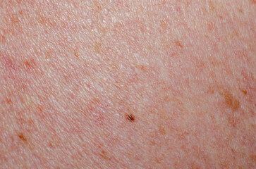 Fototapeta premium Nevus on human skin close-up