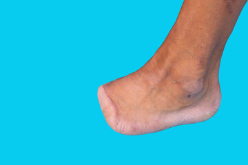 Amputation of all toes of a diabetic man's foot, diabetic foot, shampoo. Diabetes. Close-up....