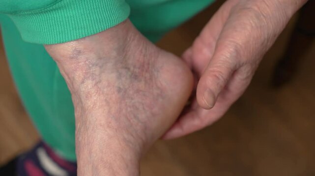 Elderly woman scratches her heel. Close up old female foot with dry skin and varicose veins. Age related changes in skin and vascular conductivity of senior person. Care for elderly persons medicine