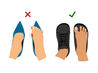 Barefoot Shoes.  Feet with Bunions.  Compare regular narrow shoes and barefoot shoes. Tight shoes and heels lead to problems with the feet, bone deformation, redness and inflammation