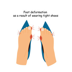 Barefoot shoes. Feet with bunions.  Narrow heeled shoes. Tight shoes and heels lead to foot problems, bone deformities, redness and inflammation