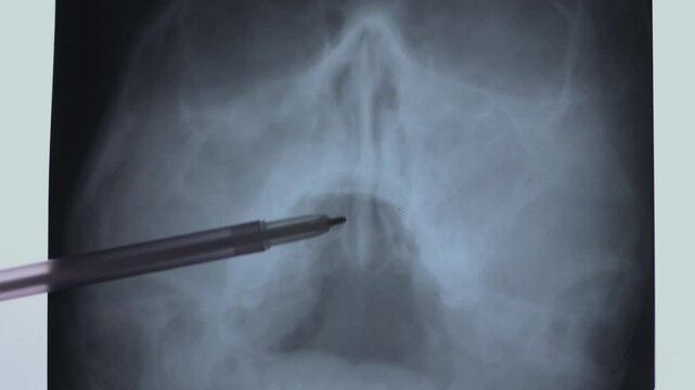 Doctor learning X-ray scan of skull facial asymmetry. Head with deviated nasal septum. 4k footage.