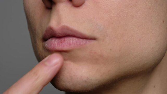 Close-up of a young man pointing to dry lips with his finger, emphasizing the need for moisturizing. Extremely dry cause of an allergies due to use of beauty products or due to the weather.