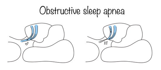 Obstructive sleep apnea