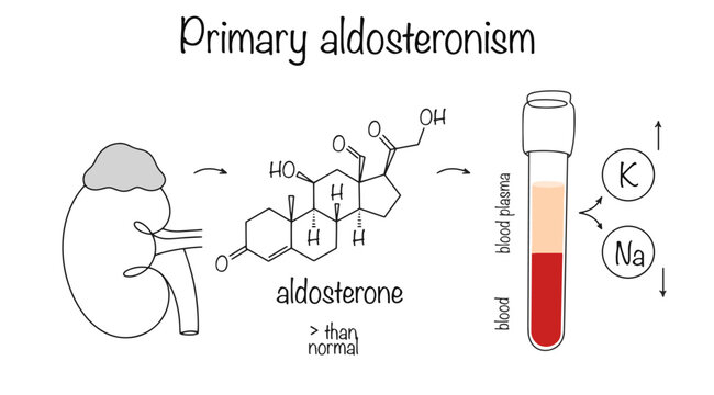 Primary aldosteronism