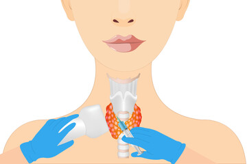 Thyroid cancer disease, nodules, ultrasound screening, medical treatment, fine needle aspiration, lumps, test lab, gland, neck pain