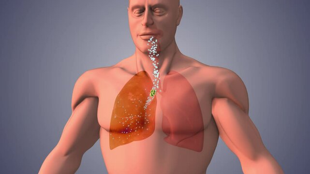 Collapsed Lung Condition Reducing Oxygen and Airflow Efficiency