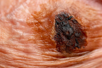 Spot removal by laser Macro photo of human hpv papillomavirus, man with skin lesion by virus