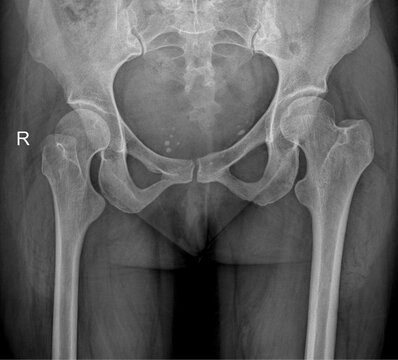 Fractured Female Pelvis AP X-ray