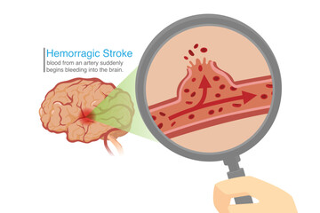 Brain Scan with Magnifying glass for looking at arteries in the brain with bleeding. Illustration about Hemorrhage Stroke cause of dead or apoplectic.