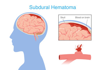 Subdural hematoma from head injury make bleeding into the brain area very rapidly and compressing brain tissue. Medical diagram.