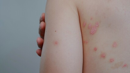 Fototapeta premium Small patches of Psoriasis in a man's back. Skin with psoriasis.