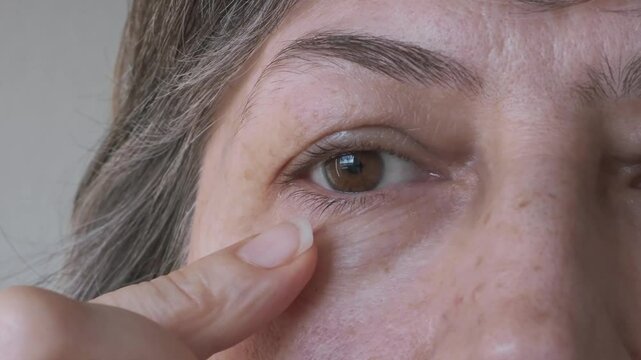 Close-up of a woman's face with grey hair, examining her bags under her eyes and swollen upper eyelids. Concept of plastic surgery of the face, eyelid lift, blepharoplasty, cosmetology, lymphatic drai