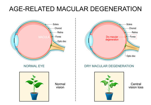 Macular degeneration. Age-related dry macular degeneration. AMD.