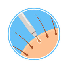 Punch incision hair transplantation step