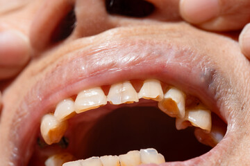 Attrition tooth due to interaction with other teeth in elderly woman.