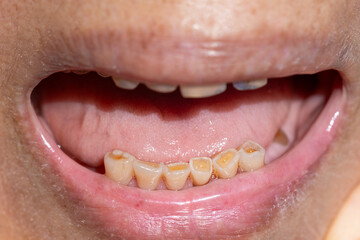 Attrition tooth due to interaction with other teeth in elderly woman.