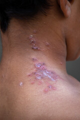 Close-Up of Skin Infection on the Neck