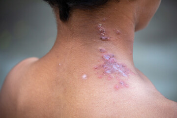 Fototapeta premium Close-Up of Skin Infection on the Neck