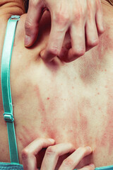 Woman scratching her itchy back with allergy rash
