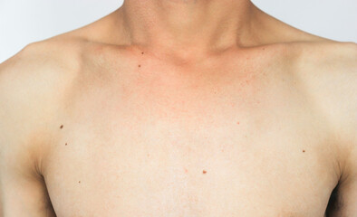 Naklejka premium Skin disease beauty male 