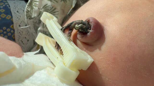 Close-Up of Newborn Umbilical Cord with Medical Clamp - Neonatal Care