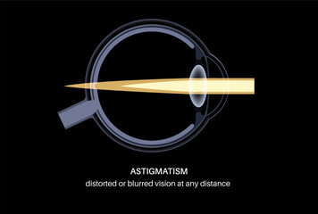 Astigmatism eye disease