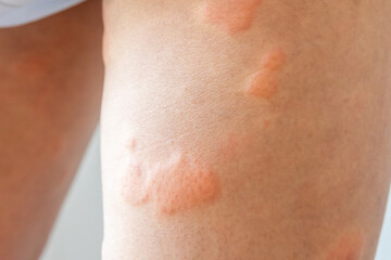 Fototapeta premium Young asian man has allergic skin rash on his legs from itchy dry skin eczema dermatitis insect bites