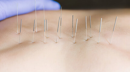 Acupuncture needles on a patient's back
