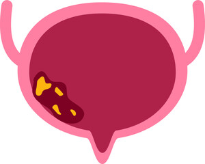 bladder disease. Urinary tract infection Illustration