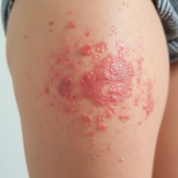 Safe and Effective Ligelizumab Treatment for Chronic Spontaneous Urticaria