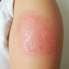 Fototapeta premium Safe and Effective Ligelizumab Treatment for Chronic Spontaneous Urticaria